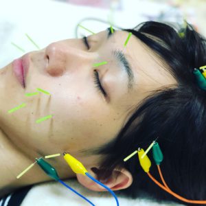 19歳 専門学生 （男性）美容鍼1回目 | Acupuncture BISHIN